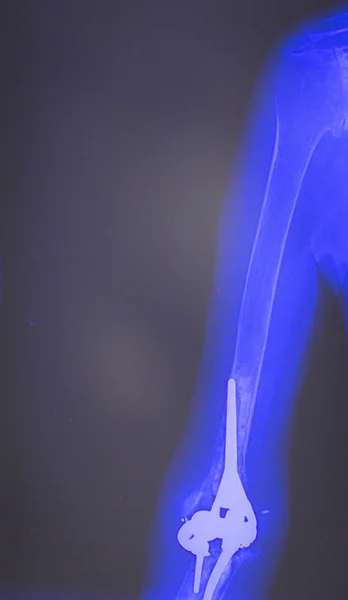 肘臂骨科植入物的 x 射线扫描 — 图库照片