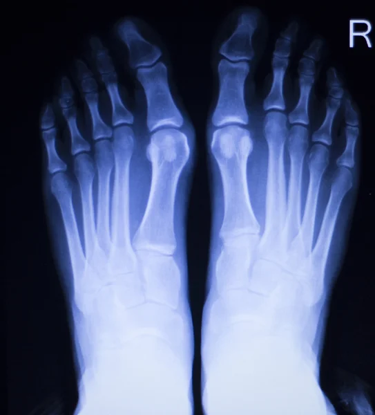 Lesión de pies y dedos de los pies Radiografía — Foto de Stock