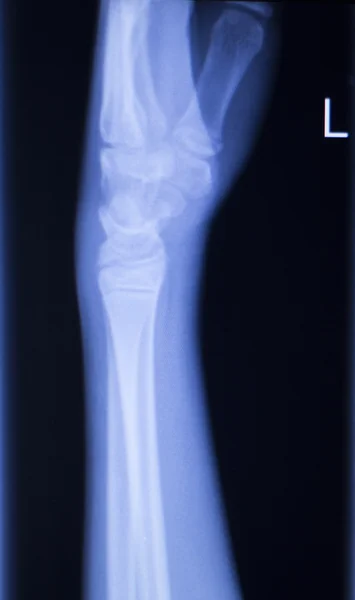 Рука передпліччя і рентген ліктя — стокове фото