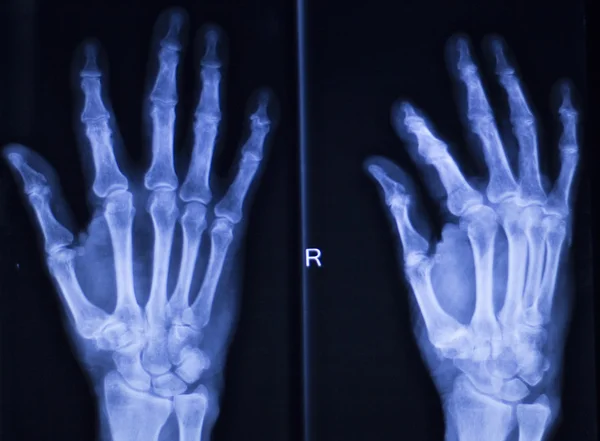 Mão dedos polegar pulso xray varredura — Fotografia de Stock