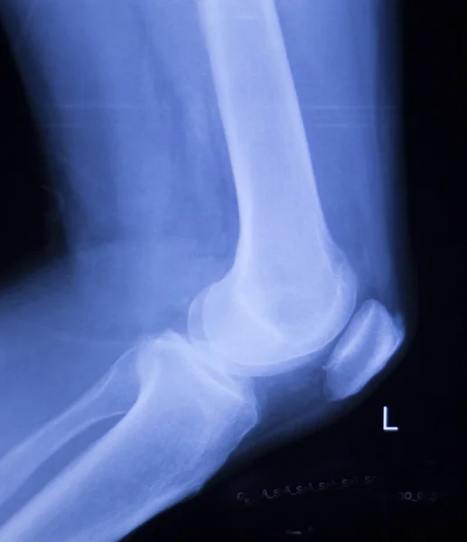 Térd- és meniscus sérülés xray scan — Stock Fotó