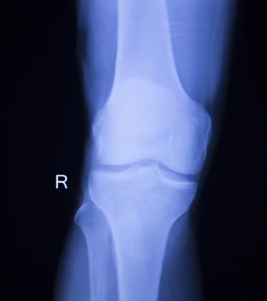 Lesión de rodilla y menisco Tomografía de rayos X —  Fotos de Stock