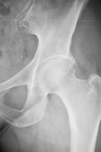 Lesión de cadera rayos X exploración médica —  Fotos de Stock