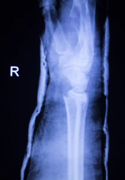 Exploración por rayos X de antebrazo y codo — Foto de Stock