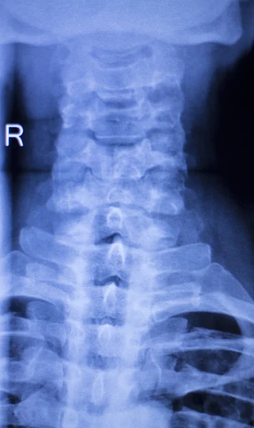 Spine vertebra back injury xray scan — Stock Photo, Image