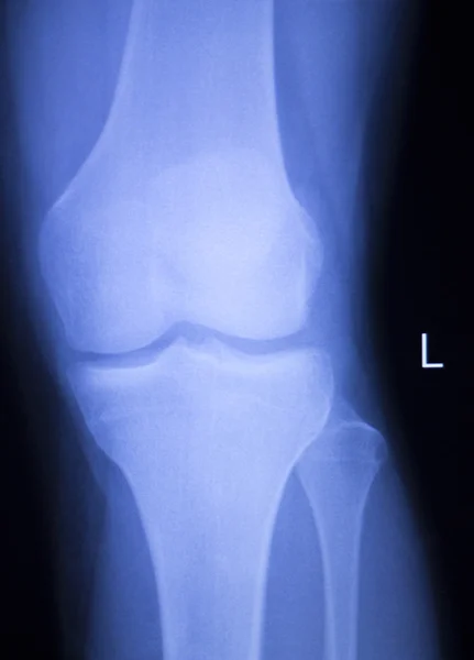 Knie en de meniscus letsel xray scan — Stockfoto