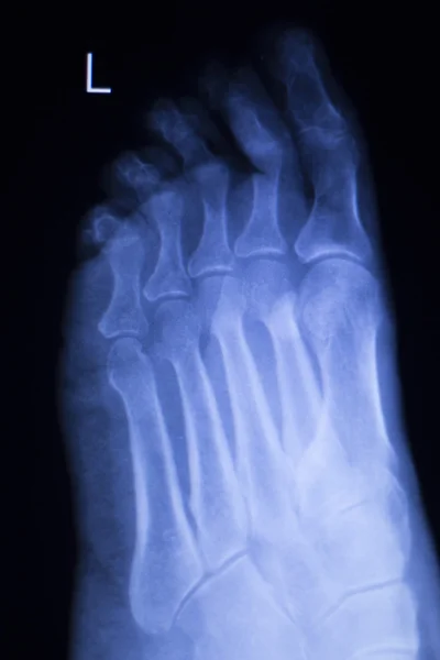 Foot and toes injury xray scan — Stock Photo, Image