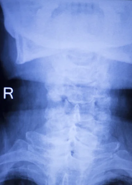 Skull neck spine shoulders xray scan — Stock Photo, Image