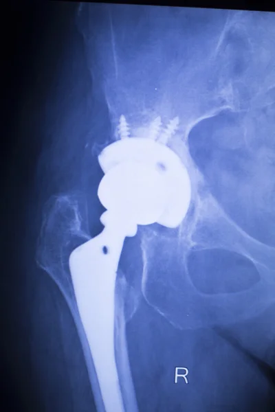 Kalça protezi xray ortopedi tıbbi tarama — Stok fotoğraf