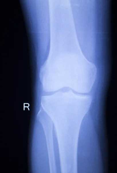 Diz ve Menisküs yaralanma xray tarama — Stok fotoğraf