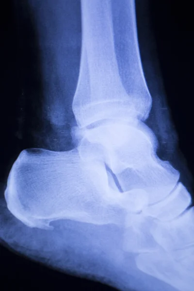 脚踵踝关节损伤 x 射线扫描 — 图库照片