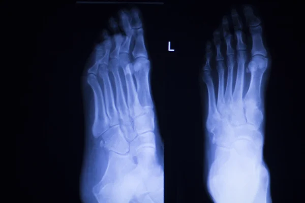 Ayak ve ayak parmakları yaralanma xray tarama — Stok fotoğraf