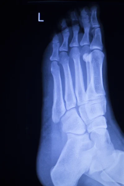 Foot and toes injury xray scan — Stock Photo, Image