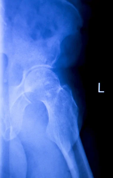 Hip injury xray medical scan
