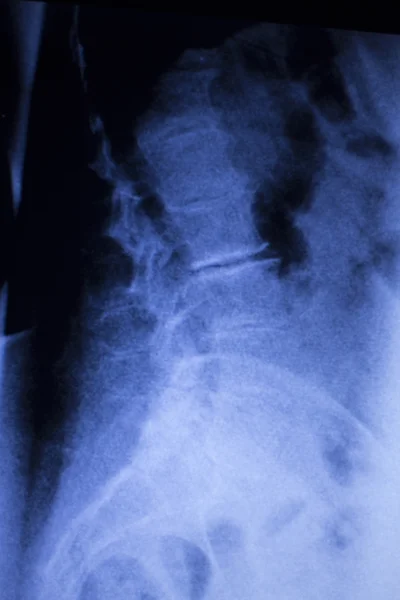 Vértebra vertebral lesión lumbar exploración por rayos X — Foto de Stock