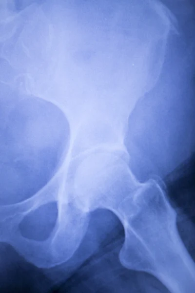 Hip zranění xray lékařské kontroly — Stock fotografie