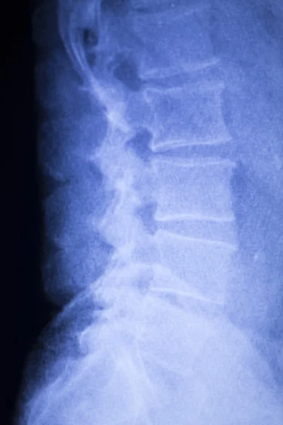 Rückenverletzung Wirbelsäule Röntgenbild — Stockfoto