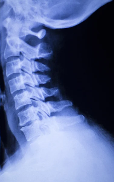 Koponya nyaki gerinc váll xray scan — Stock Fotó