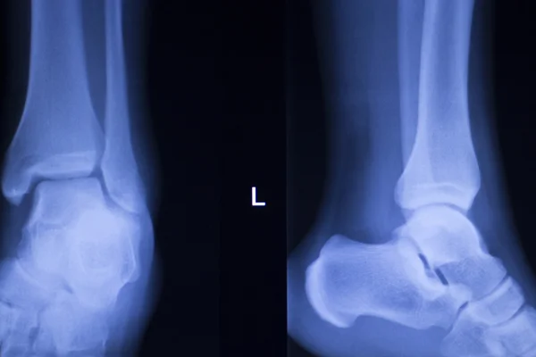 Рентген на ноге с травмой ноги — стоковое фото