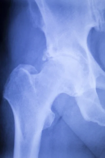 Radiografía de reemplazo de cadera exploración médica ortopédica — Foto de Stock