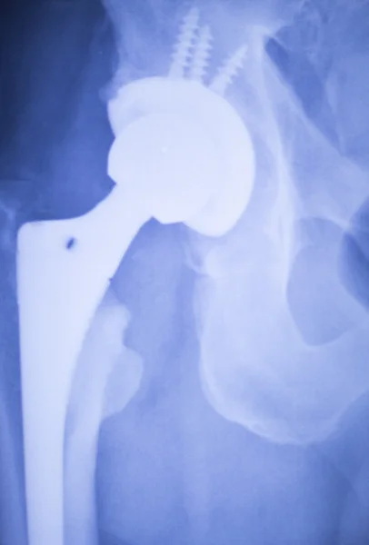 Hip replacement xray orthopedic medical scan — Stock Photo, Image