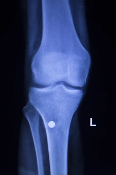 Genou blessure vis implant radiographie — Photo