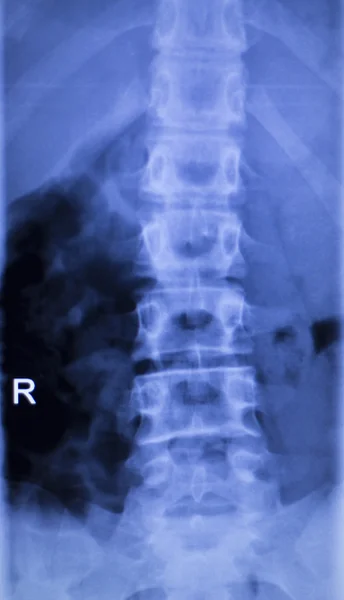 Spine vertebra back injury xray scan — Stock Photo, Image