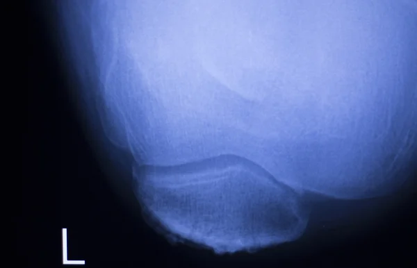 Knee and meniscus injury xray scan