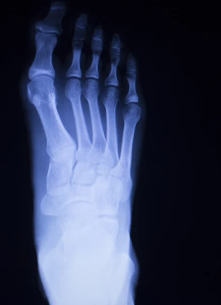 Pé e dedos dos pés lesão raio X varredura — Fotografia de Stock