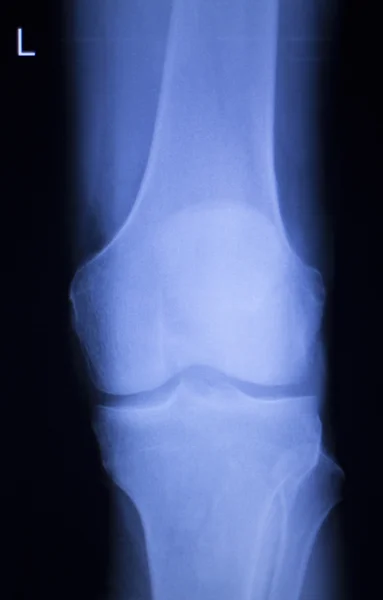 Сканування рентгенівського знімка коліна та меню — стокове фото
