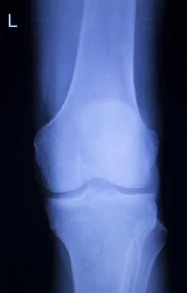 Térd- és meniscus sérülés xray scan — Stock Fotó