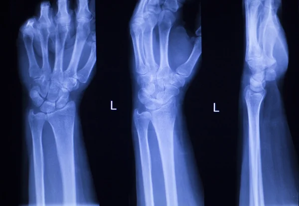 Mão dedos polegar pulso xray varredura — Fotografia de Stock