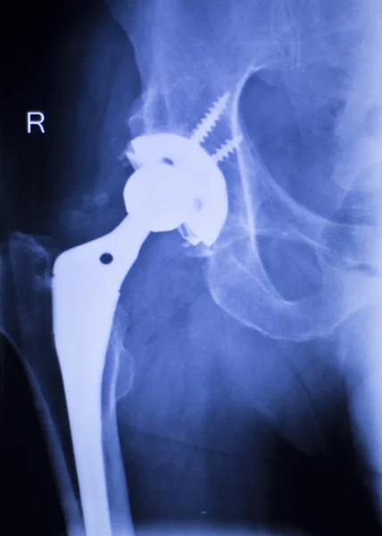 Заміна кульшового рентгенівського ортопедичного медичного сканування — стокове фото