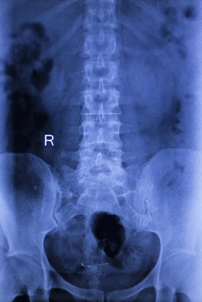 Spine vertebra back injury xray scan — Stock Photo, Image