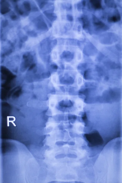 Varredura de raio-x de lesão na coluna vertebral — Fotografia de Stock