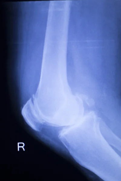 Rastreamento da lesão do joelho e do menisco — Fotografia de Stock