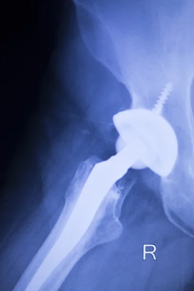 Höftleden ortopediska ersättare implantat — Stockfoto
