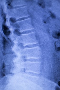 Omurga omur sırt yaralanması xray tarama