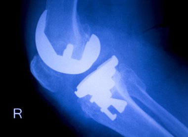 Diz ortopedik implant xray tarama