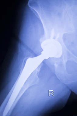 Kalça protezi xray ortopedi tıbbi tarama