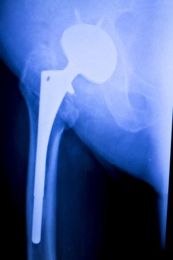 Kalça protezi xray ortopedi tıbbi tarama