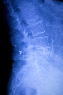 Omurga omur sırt yaralanması xray tarama