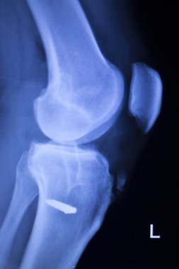 Diz yaralanma vida implant xray tarama