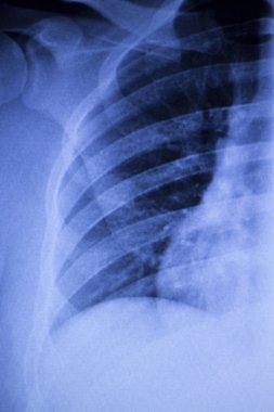 Omurga omur kaburga yaralanması xray tarama geri