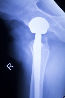 Kalça protezi xray ortopedi tıbbi tarama