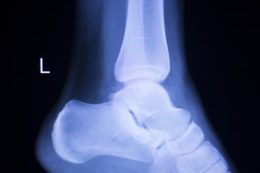 Ayak topuk ayak bileği yaralanması xray inceden inceye gözden geçirmek