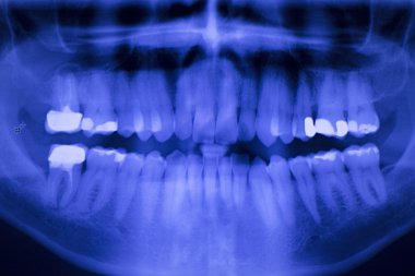 Diş diş diş hekimleri xray tarama doldurma