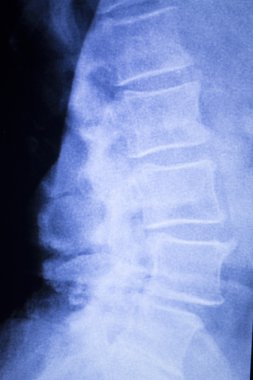 Omurga omur sırt yaralanması xray tarama