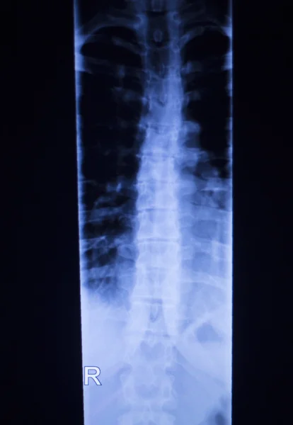Spine vertebra back injury xray scan — Stock Photo, Image
