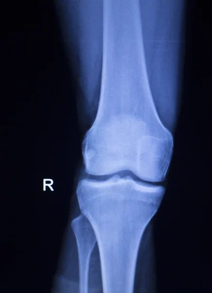 Lesión de rodilla y menisco Tomografía de rayos X — Foto de Stock